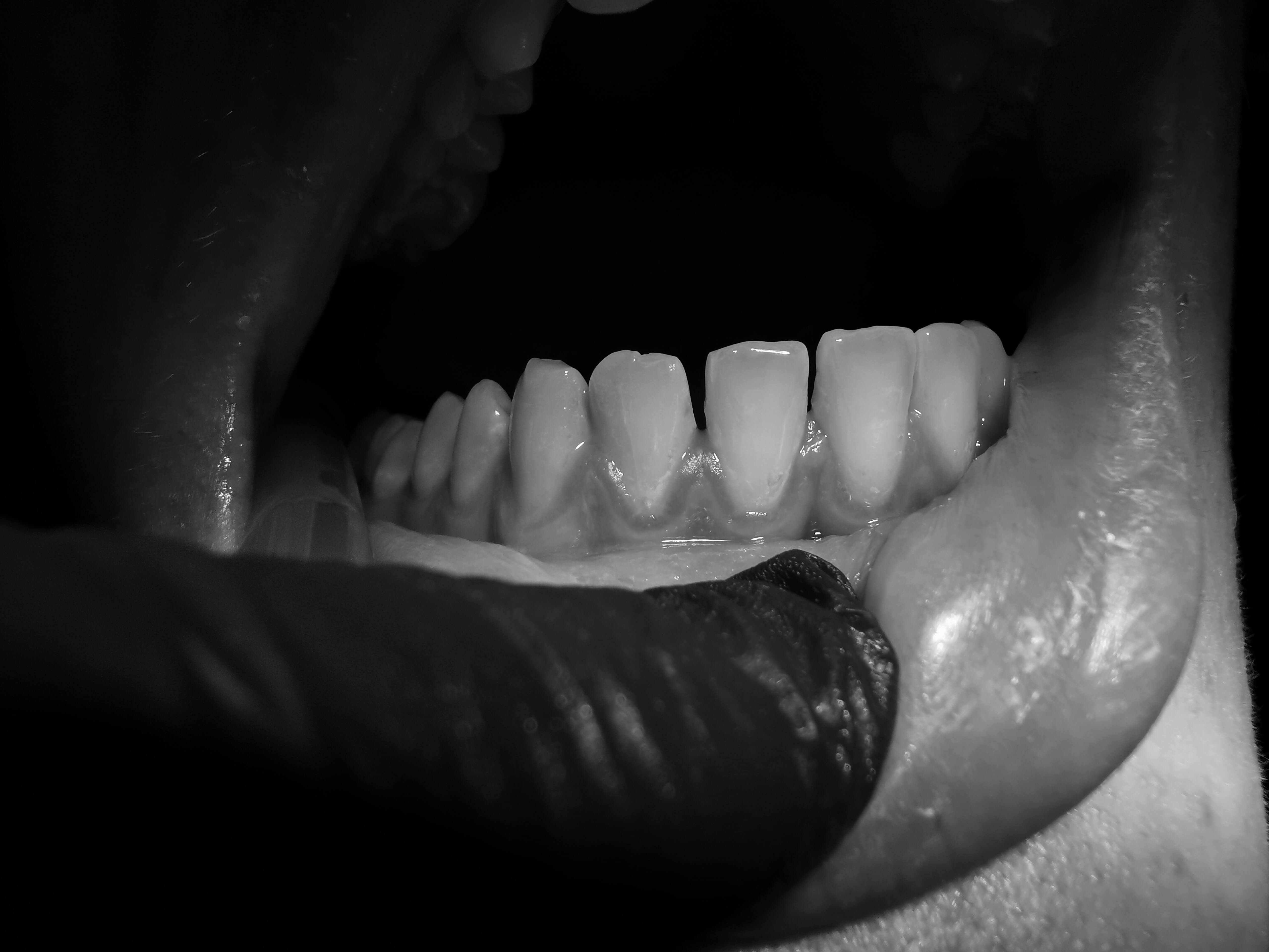 Bifluorid fogzománc védő kezelés érzékenység ellen