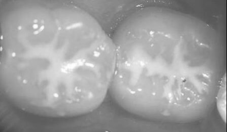 Barázda zárás gyermekeknél, tejfog szuvasodás ellen